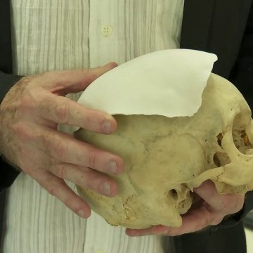 Projeto na Fiocruz desenvolve nova tecnologia 20 vezes mais barata para reconstruir defeitos ósseos
