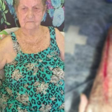 Crivella inaugura tomógrafo em hospital onde idosa foi cortada ao retirar gesso e pede desculpas