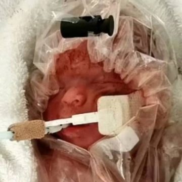 Mãe conta como médicos salvaram seu bebê prematuro ao envolvê-lo em um saco de plástico
